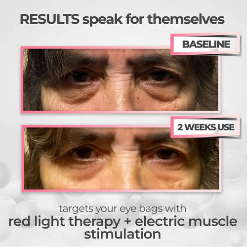 LumiEyes 2-in-1 Red Light Therapy + EMS To Erase Eye Bags