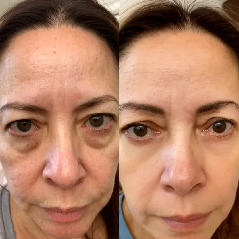 LumiEyes 2-in-1 Red Light Therapy + EMS To Erase Eye Bags